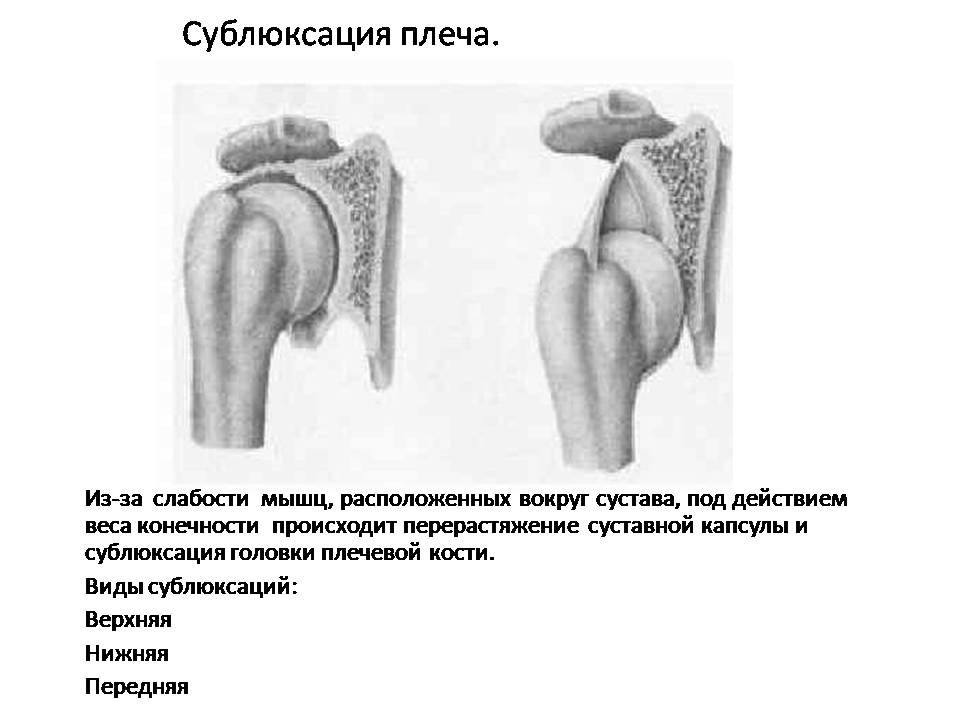 Наталья Панкина "Реабилитация после инсульта"