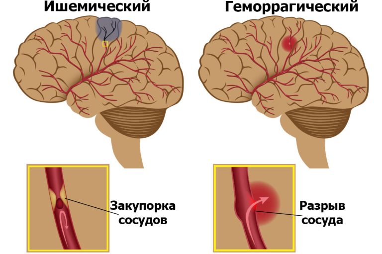 Инсульт это Реабилитация инсульта