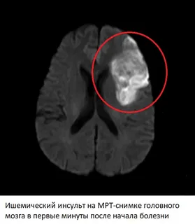 Мозг после инсульта на мрт